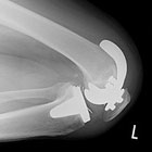 人工膝関節置換術の画像