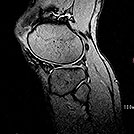 膝関節T2強調像の画像
