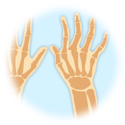手指の関節リウマチimage