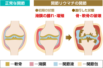 正常な関節と関節リウマチの関節 概念図