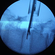 内視鏡下椎間板ヘルニア摘出術の画像