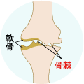 変形性膝関節症 概念図
