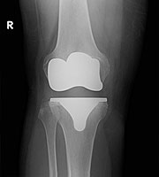 人工膝関節置換術レントゲン写真