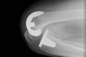 人工膝関節置換術レントゲン写真