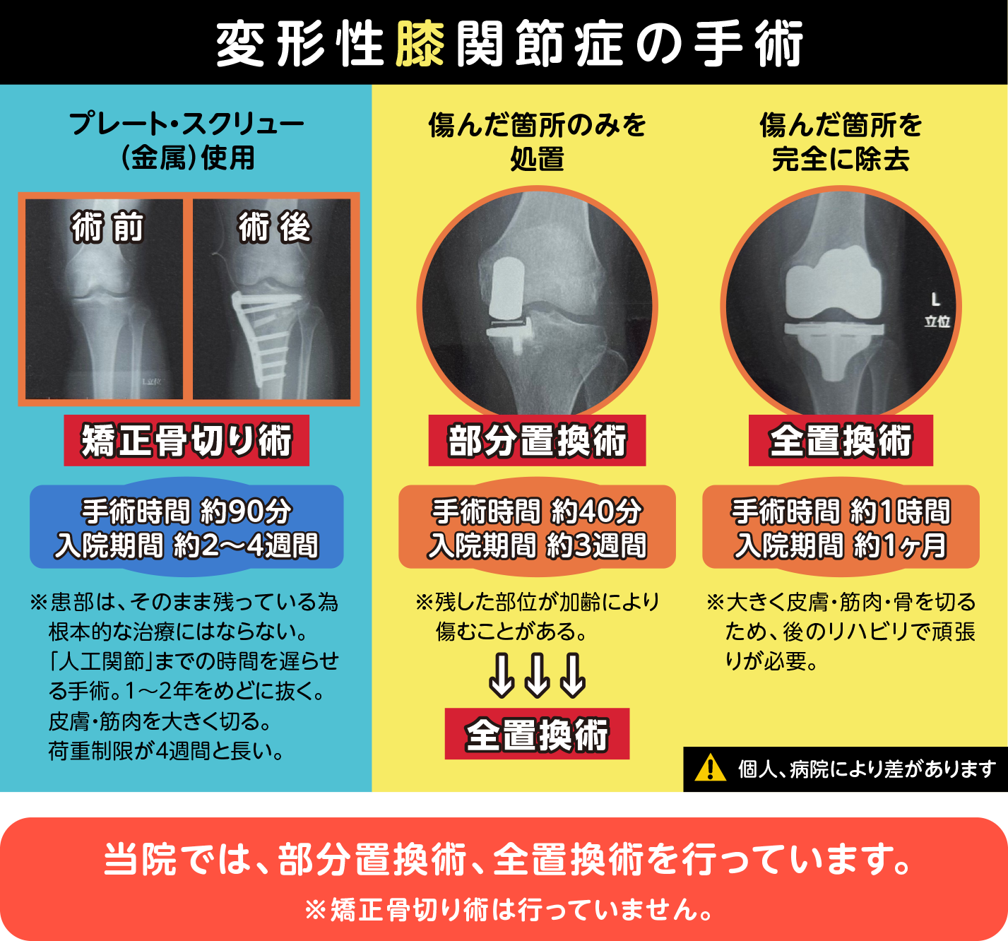 変形性膝関節症の手術